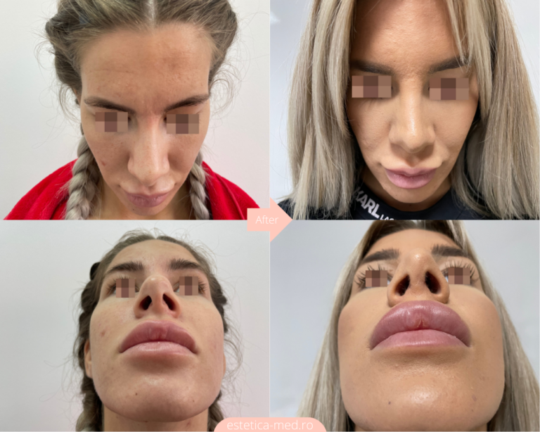 Înainte și după — Rinoplastie — Dr. Ivan Vatamanesku