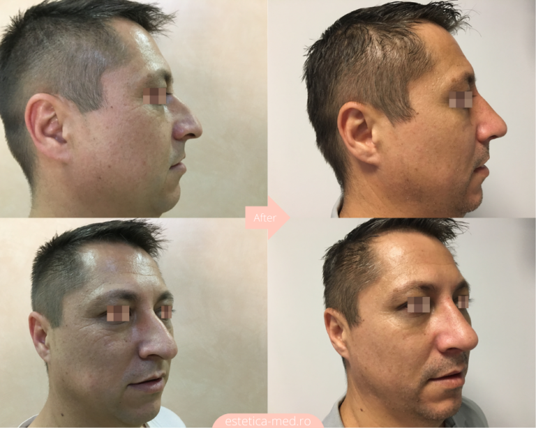 Înainte și după — Rinoplastie — Dr. Ivan Vatamanesku