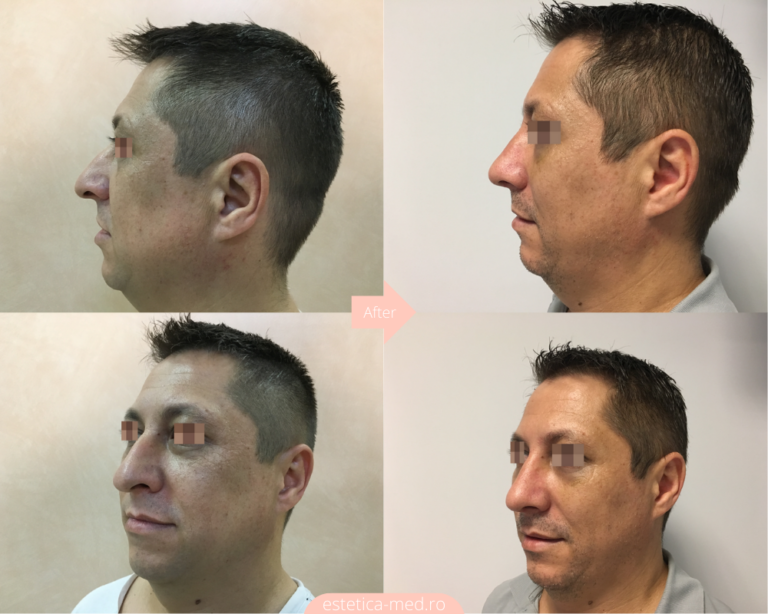 Înainte și după — Rinoplastie — Dr. Ivan Vatamanesku