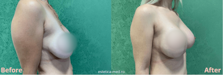 Înainte și după — Implant mamar — Dr. Ivan Vatamanesku